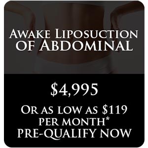 Awake Liposuction of Abdominal Awake Liposuction of Abdominal