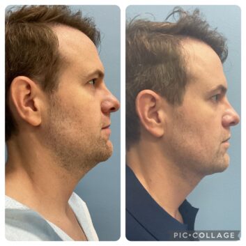 HD LipoX® of Jawline at Face Works Plastic Surgery, Plastic Surgeon Near Me in Schaumburg, IL