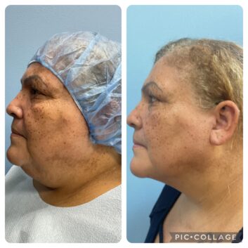 Before and After HD LipoX® of Jawline at Face Works Plastic Surgery, Plastic Surgeon Near Me in Schaumburg, IL