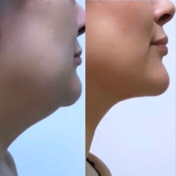 Before and After HD LipoX® of Jawline at Face Works Plastic Surgery, Plastic Surgeon Near Me in Schaumburg, IL