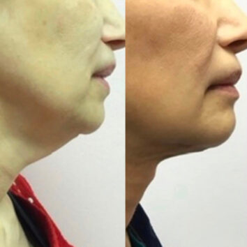Before and After HD LipoX® of Jawline at Face Works Plastic Surgery, Plastic Surgeon Near Me in Schaumburg, IL