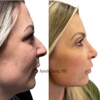 Before and After HD LipoX® of Jawline at Face Works Plastic Surgery, Plastic Surgeon Near Me in Schaumburg, IL