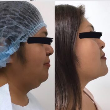 HD LipoX® of Jawline at Face Works Plastic Surgery, Plastic Surgeon Near Me in Schaumburg, IL