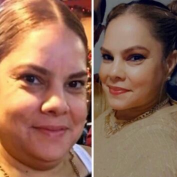 Before and After HD LipoX® of Jawline at Face Works Plastic Surgery, Plastic Surgeon Near Me in Schaumburg, IL