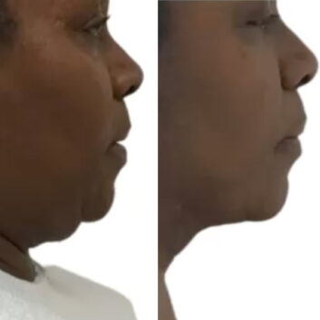 Before and After HD LipoX® of Jawline at Face Works Plastic Surgery, Plastic Surgeon Near Me in Schaumburg, IL