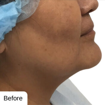 Before and After HD LipoX® of Jawline at Face Works Plastic Surgery, Plastic Surgeon Near Me in Schaumburg, IL