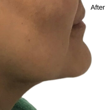 Before and After HD LipoX® of Jawline at Face Works Plastic Surgery, Plastic Surgeon Near Me in Schaumburg, IL