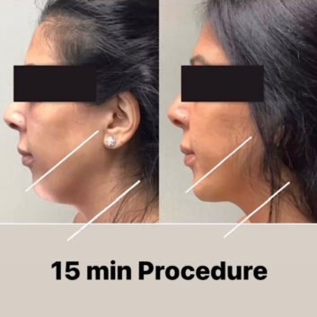 Before and After HD LipoX® of Jawline at Face Works Plastic Surgery, Plastic Surgeon Near Me in Schaumburg, IL