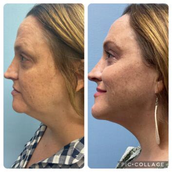 Before and After HD LipoX® of Jawline at Face Works Plastic Surgery, Plastic Surgeon Near Me in Schaumburg, IL