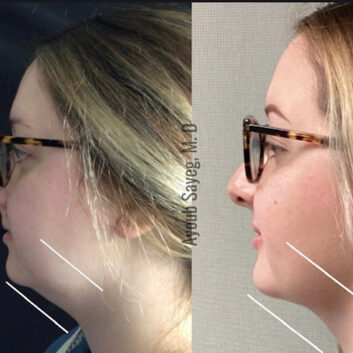 Before and After HD LipoX® of Jawline at Face Works Plastic Surgery, Plastic Surgeon Near Me in Schaumburg, IL