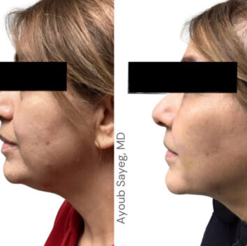 Before and After HD LipoX® of Jawline at Face Works Plastic Surgery, Plastic Surgeon Near Me in Schaumburg, IL