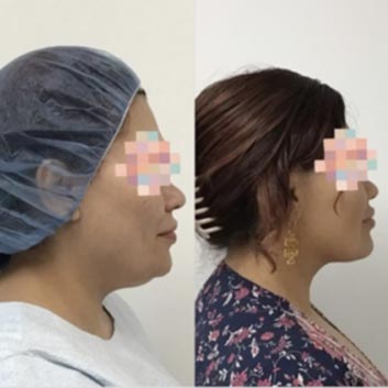 Before and After HD LipoX® of Jawline at Face Works Plastic Surgery, Plastic Surgeon Near Me in Schaumburg, IL