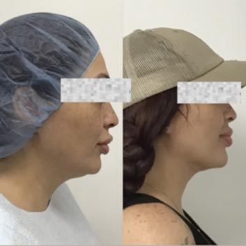 Before and After HD LipoX® of Jawline at Face Works Plastic Surgery, Plastic Surgeon Near Me in Schaumburg, IL