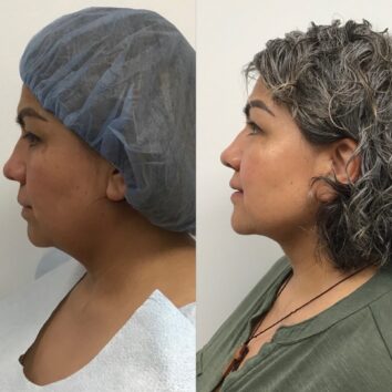 Before and After HD LipoX® of Jawline at Face Works Plastic Surgery, Plastic Surgeon Near Me in Schaumburg, IL