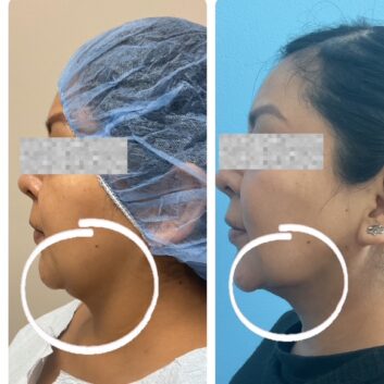 Before and After HD LipoX® of Jawline at Face Works Plastic Surgery, Plastic Surgeon Near Me in Schaumburg, IL