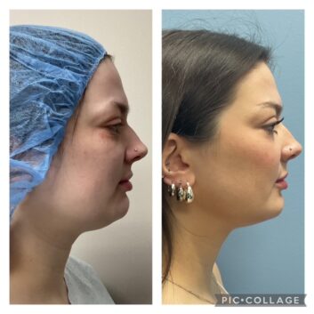 HD LipoX® of Jawline at Face Works Plastic Surgery, Plastic Surgeon Near Me in Schaumburg, IL