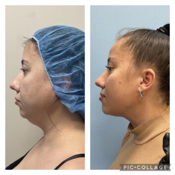 Before and After HD LipoX® of Jawline at Face Works Plastic Surgery, Plastic Surgeon Near Me in Schaumburg, IL