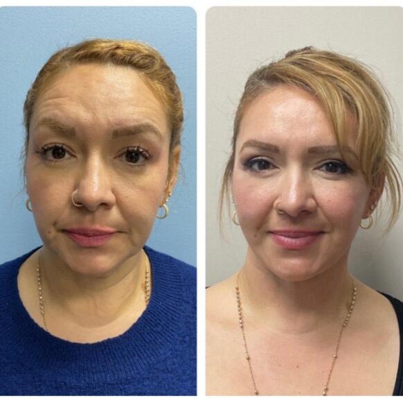 Face Lift at Face Works Plastic Surgery, Plastic Surgeon Near Me in Schaumburg, IL Face Lift at Face Works Plastic Surgery, Plastic Surgeon Near Me in Schaumburg, IL