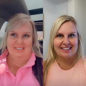 Before and After HD LipoX® of Jawline at Face Works Plastic Surgery, Plastic Surgeon Near Me in Schaumburg, IL