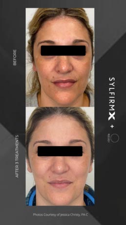 Sylfirm RF Microneedling Specialist Serving Chicago, Schaumburg, IL