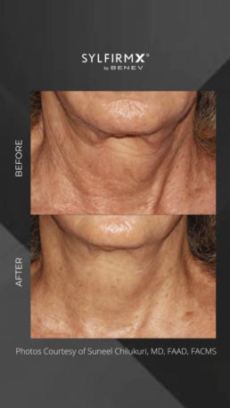 Sylfirm RF Microneedling Specialist Serving Chicago, Schaumburg, IL