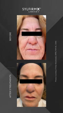 Sylfirm RF Microneedling Specialist Serving Chicago, Schaumburg, IL