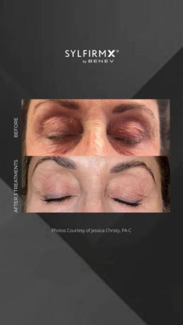 Sylfirm RF Microneedling Specialist Serving Chicago, Schaumburg, IL