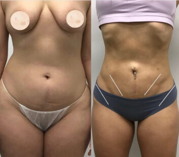 Before and After Body Liposuction at Face Works Plastic Surgery, Near Me in Schaumburg, IL