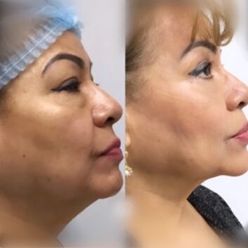 Before and After HD LipoX® of Jawline at Face Works Plastic Surgery, Plastic Surgeon Near Me in Schaumburg, IL