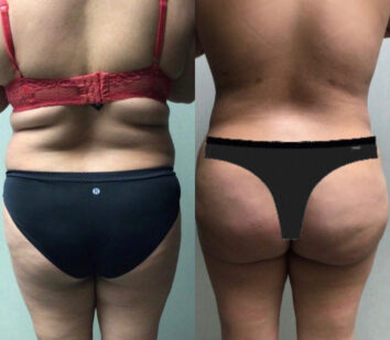 Before and After Body Liposuction at Face Works Plastic Surgery, Near Me in Schaumburg, IL