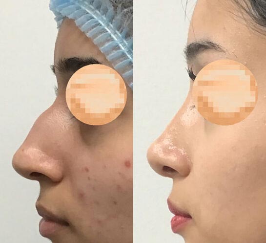 Before and After Nose Plastic Surgery at Face Works Plastic Surgery, Near Me in Schaumburg, IL