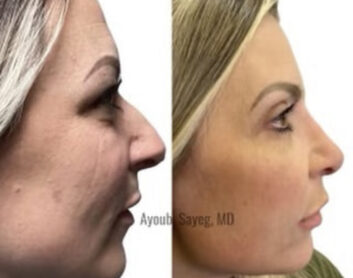 Before and After Nose Plastic Surgery at Face Works Plastic Surgery, Near Me in Schaumburg, IL