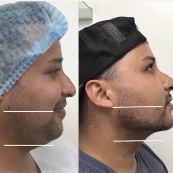Before and After HD LipoX® of Jawline at Face Works Plastic Surgery, Plastic Surgeon Near Me in Schaumburg, IL