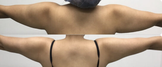 Arms Plastic Surgery at Face Works Plastic Surgery, Plastic Surgeon Near Me in Schaumburg, IL