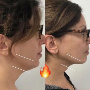 Before and After HD LipoX® of Jawline at Face Works Plastic Surgery, Plastic Surgeon Near Me in Schaumburg, IL