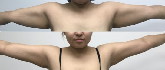Arms Plastic Surgery at Face Works Plastic Surgery, Plastic Surgeon Near Me in Schaumburg, IL