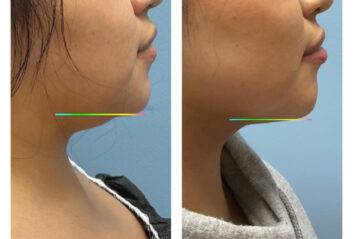 Before and After HD LipoX® of Jawline at Face Works Plastic Surgery, Plastic Surgeon Near Me in Schaumburg, IL