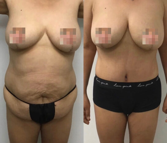 Tummy Tuck at Face Works Plastic Surgery, Plastic Surgeon Near Me in Schaumburg, IL