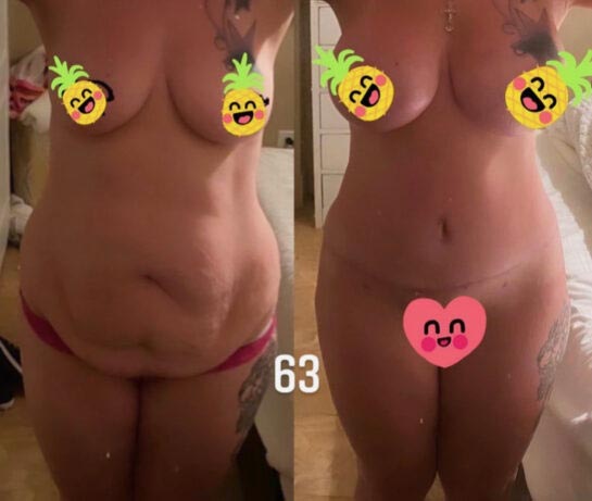 Mommy Makeover at Face Works Plastic Surgery, Plastic Surgeon Near Me in Schaumburg, IL