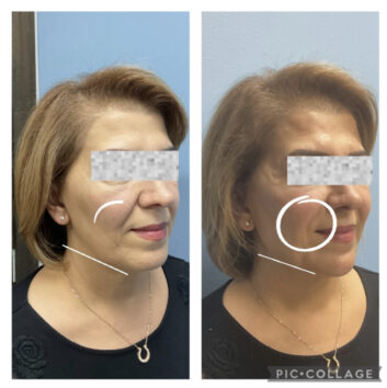 Dermal fillers at Face Works Plastic Surgery, Plastic Surgeon Near Me in Schaumburg, IL