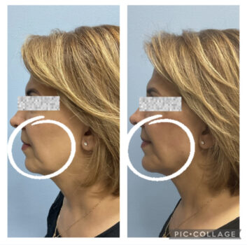 Dermal fillers at Face Works Plastic Surgery, Plastic Surgeon Near Me in Schaumburg, IL