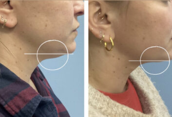 Before and After HD LipoX® of Jawline at Face Works Plastic Surgery, Plastic Surgeon Near Me in Schaumburg, IL