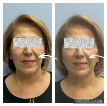 Dermal fillers at Face Works Plastic Surgery, Plastic Surgeon Near Me in Schaumburg, IL