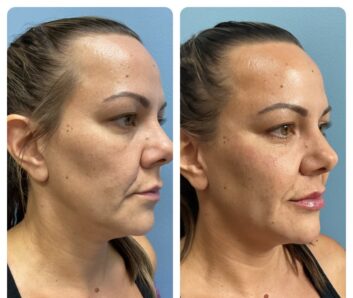 Before and After Dermal fillers at Face Works Plastic Surgery, Plastic Surgeon Near Me in Schaumburg, IL