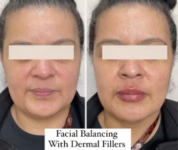 Before and After Dermal fillers at Face Works Plastic Surgery, Plastic Surgeon Near Me in Schaumburg, IL
