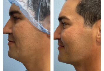 Before and After HD LipoX® of Jawline at Face Works Plastic Surgery, Plastic Surgeon Near Me in Schaumburg, IL