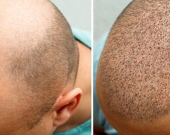 Before and After Hair Transplant/Restoration (Exosome or PRP) at Face Works Plastic Surgery, Plastic Surgeon Near Me in Schaumburg, IL