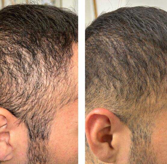 Before and After Hair Transplant/Restoration (Exosome or PRP) at Face Works Plastic Surgery, Plastic Surgeon Near Me in Schaumburg, IL