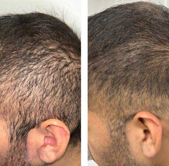 Before and After Hair Transplant/Restoration (Exosome or PRP) at Face Works Plastic Surgery, Plastic Surgeon Near Me in Schaumburg, IL