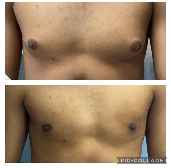 Before and After Gynecomastia at Face Works Plastic Surgery, Plastic Surgeon Near Me in Schaumburg, IL